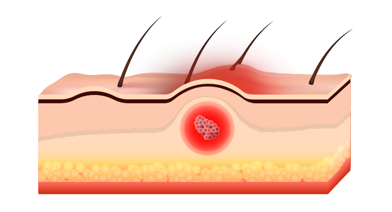 양성 종양 제거 피부질환