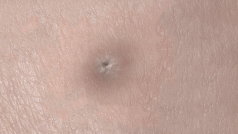 양성 종양 제거 피부질환