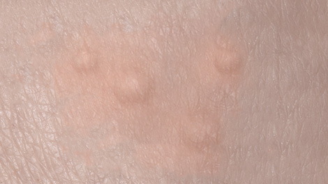 양성 종양 제거 피부질환