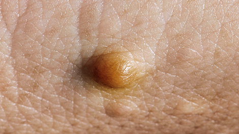 양성 종양 제거 피부질환