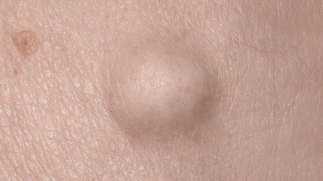 양성 종양 제거 피부질환