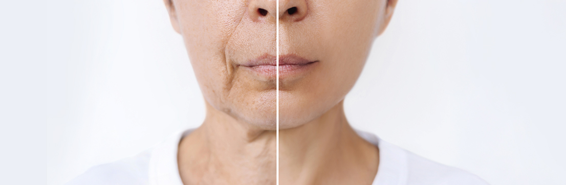 실리프팅 얼굴 윤곽, 탄력