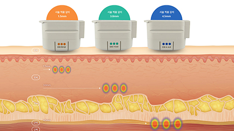지방분해주사 얼굴 윤곽, 탄력